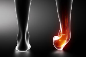 3D illustration of a Sprained ankle black x-ray.