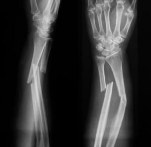 X-ray image of broken forearm, AP and lateral view
