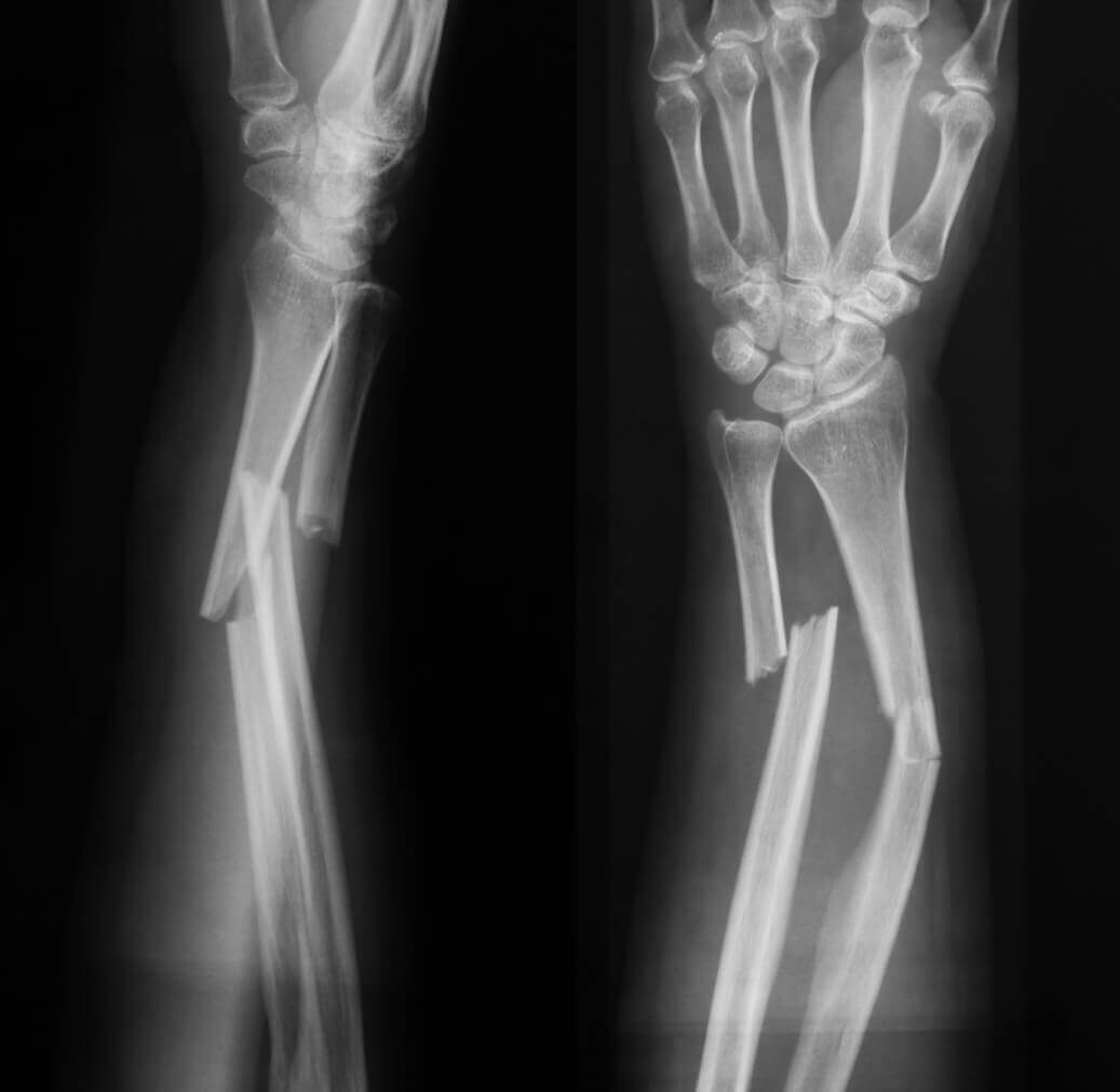 X-ray image of broken forearm, AP and lateral view